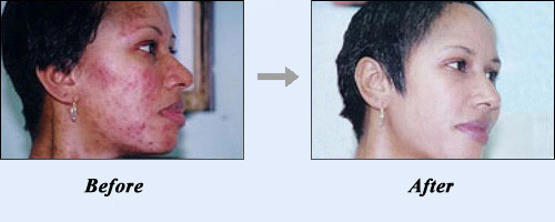 Acne treatment