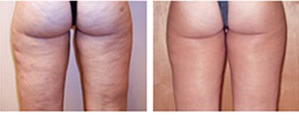 Cellulite Removal Bergen County - Cellulite Treatment and Elimination