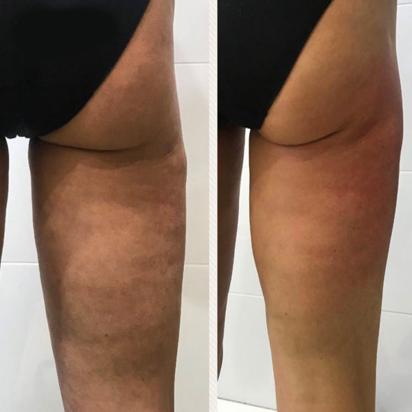 Goodbye Cellulite Before and After Results 